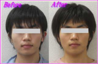 顔の歪み-頬骨の出っ張り改善