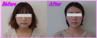 顔の歪み-エラ張り改善2年以上持続中