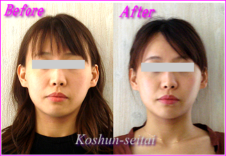  顔の歪み矯正-顔の歪みが改善された事例