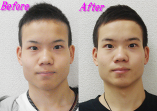 顔の歪みと顎関節症が改善-札幌の顎関節症施術