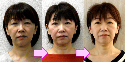 札幌 顔歪み矯正-小顔促進して顔の歪みが改善