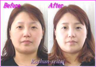顔の歪み改善-小顔促進