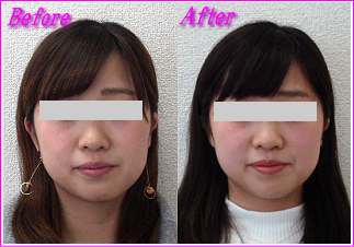 顔の歪み-左右非対称が改善
