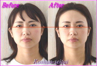 札幌-小顔矯正で目の高さの違い改善