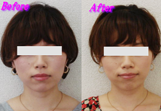 札幌-顎関節症改善の小顔矯正