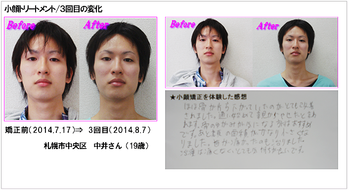 小顔矯正メンズ