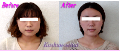 札幌 小顔矯正専門美容整体-エラ張り改善