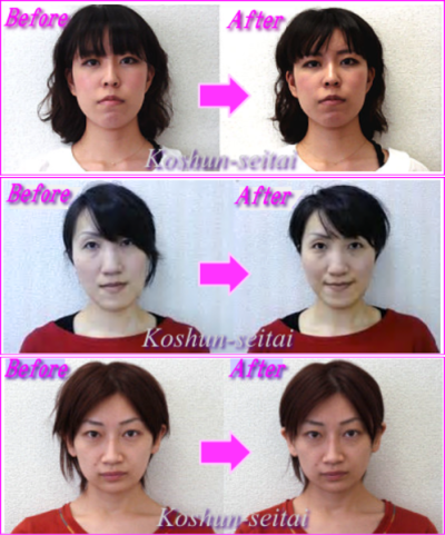 小顔矯正初回の変化2