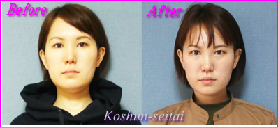 顔の歪み改善された札幌の小顔矯正専門美容整体