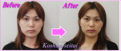 小顔になって面長改善する札幌の小顔矯正専門美容整体院