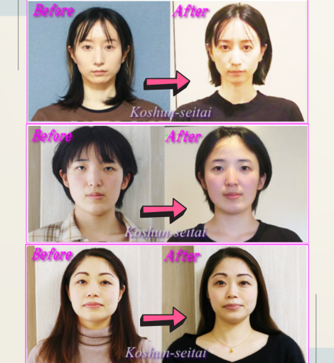 目の大きさ左右非対称を改善 / 小顔専門美容整体　札幌市中島公園駅