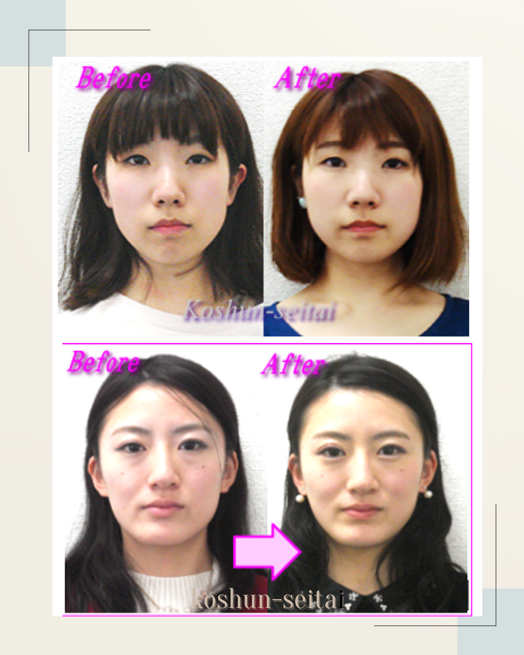 小顔矯正で面長解消