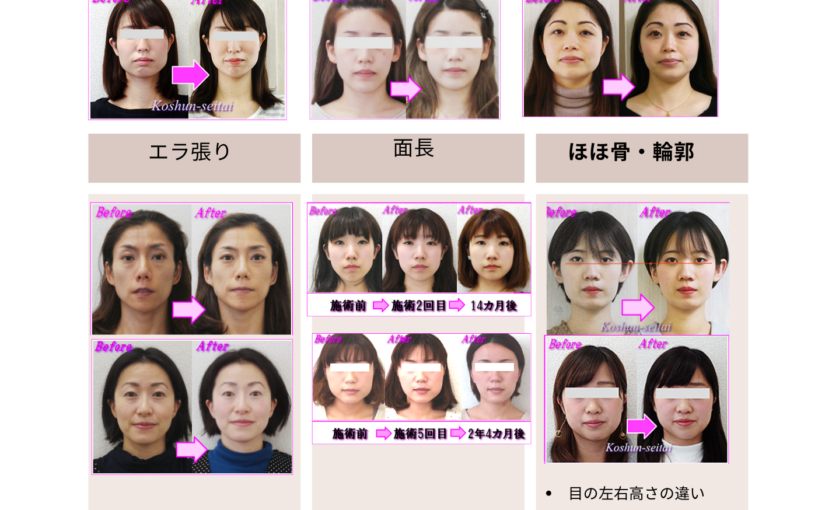 「顔が大きくなった…？」と感じたら。たるみ・面長・ハイフ効果なしに悩む札幌の女性に届けたい小顔矯正とは？