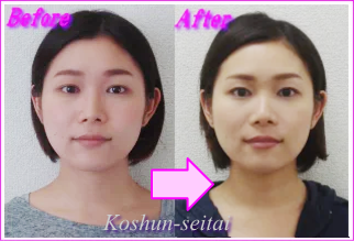 小顔矯正でフェイスラインすっきり
