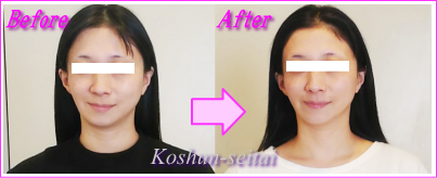 顔の歪み矯正でほほ骨改善