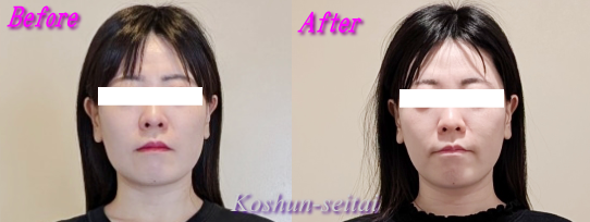 札幌 小顔フェイスラインすっきり！ ビフォーアフター 弘俊整体院