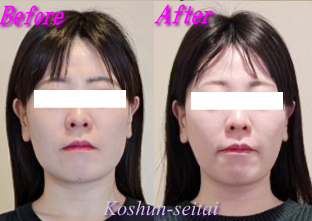 札幌 小顔矯正 ビフォーアフター 弘俊整体院