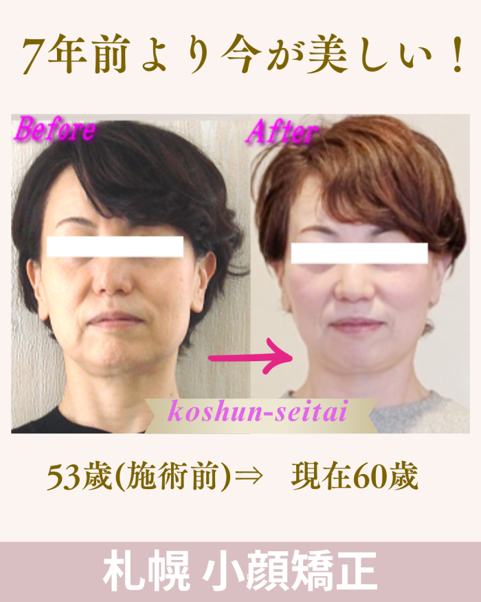 修正後: 札幌 小顔矯正 ビフォーアフター 60代