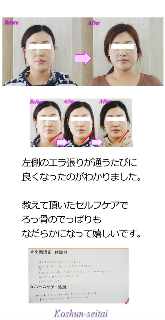 エラ張り、あばら骨の出っ張りスッキリ改善