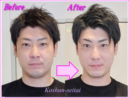 札幌の小顔矯正専門店で小顔に整いました