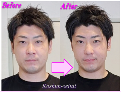 小顔矯正でフェイスライン改善